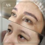 تصویر 1 میکروبلیدینگ ( فیبروز ) لیفت مژه و ابرو