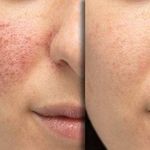 تصویر 0 پاکسازی ودرمان صورت