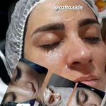 تصویر 3 جوانسازی،پاکسازی وفیشیال تخصصی اتاق پوست آزیتا