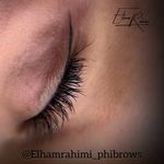 تصویر 3 میکروبلیدینگ اسکالپ سر الهام رحیمی