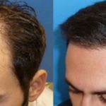 تصویر 1 کاشت ابرو، مو، ریش در شیراز