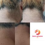 تصویر 0 اپیلاسیون تخصصی بدن بانوان در ساری