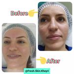 تصویر 0 فشیال و پاکسازی تخصصی پوست آرامیس