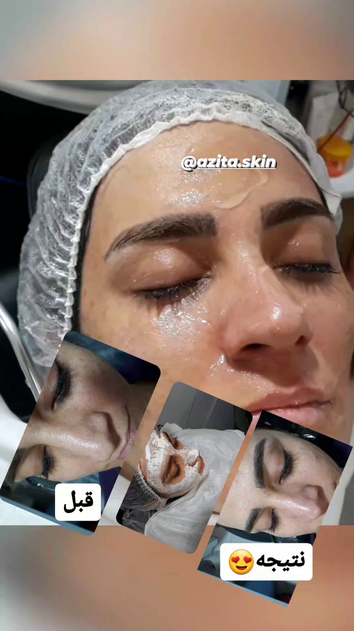 جوانسازی،پاکسازی وفیشیال تخصصی اتاق پوست آزیتا
