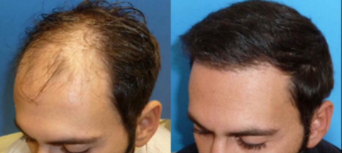 کاشت ابرو، مو، ریش در شیراز