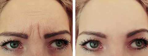 کاشت ابرو، مو، ریش در شیراز