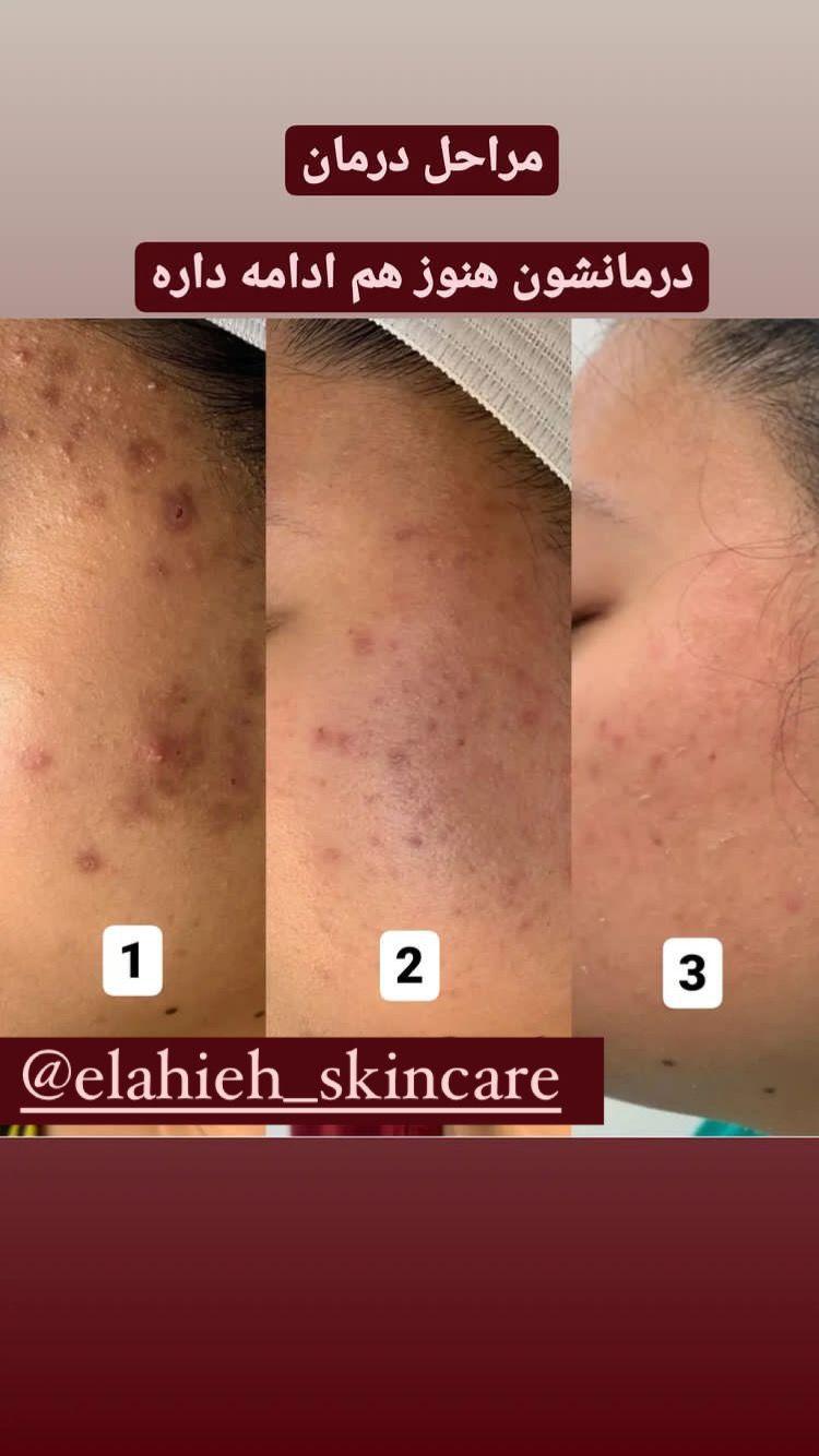 پاکسازی پوست و درمان مشکلات پوستی