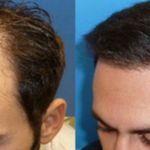 کاشت ابرو، مو، ریش در شیراز